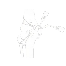 Ανακατασκευή ACL