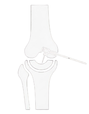 Χειρουργική Μηνίσκων